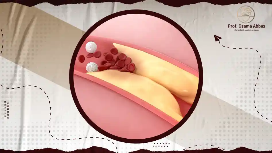 علاج الدهون الثلاثيه والكلسترول وتصلب الشرايين خلال اسبوعين