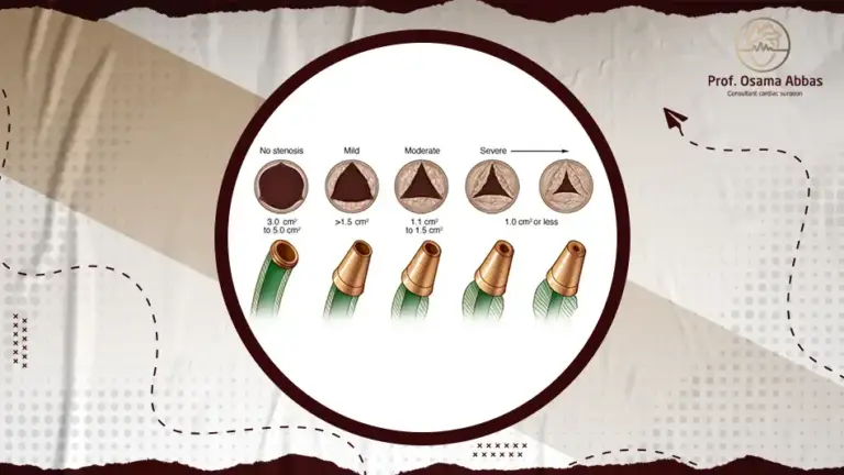 ما هي درجات ارتجاع الصمام الاورطى؟