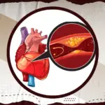 علاج انسداد شرايين القلب بدون جراحة