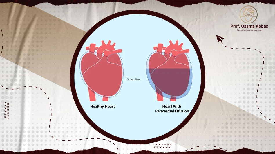 علاج تجمع الماء حول القلب على حسب السبب وكذلك حالة المريض الصحية ففي الحالات البسيطة قد يكتفي الطبيب بعمل متابعة دورية للمريض كل فترة لتفقد حالته